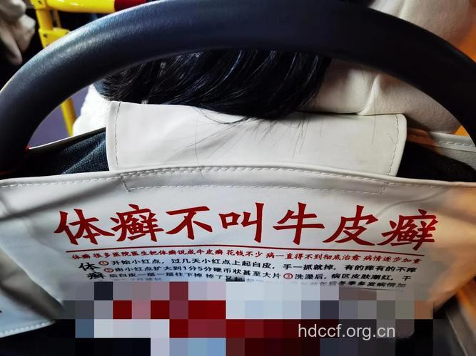 牛皮癣治疗需警惕虚假广告