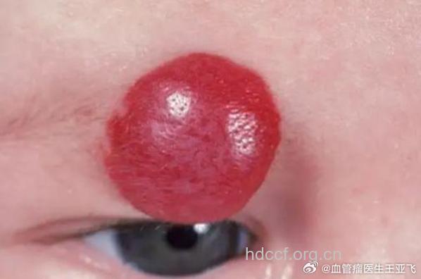 什么是眶血管瘤