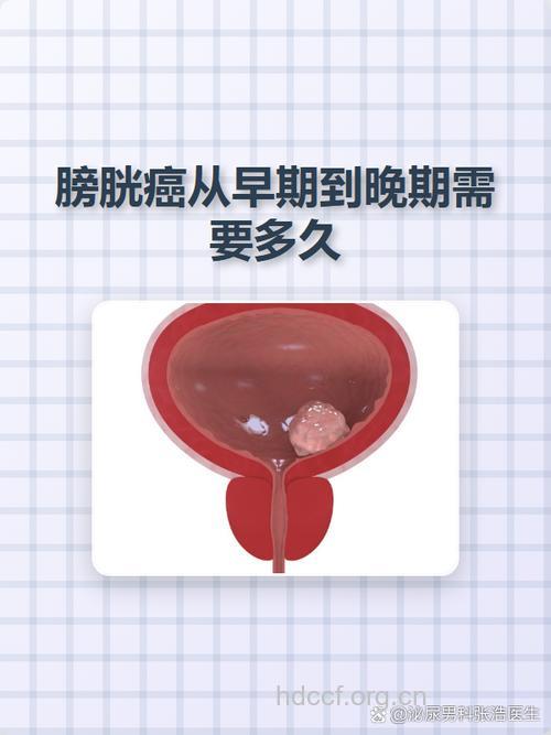 膀胱癌晚期的患者能活多久