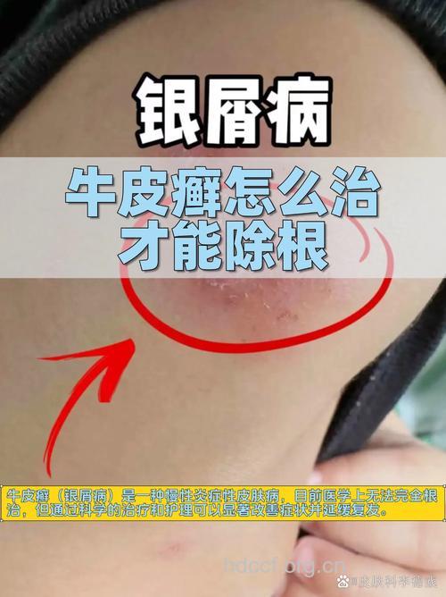 心态不好 容易让牛皮癣复发