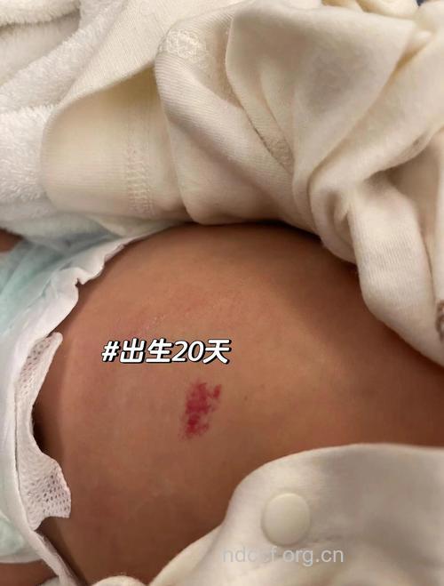 婴儿血管瘤手术前如何护理
