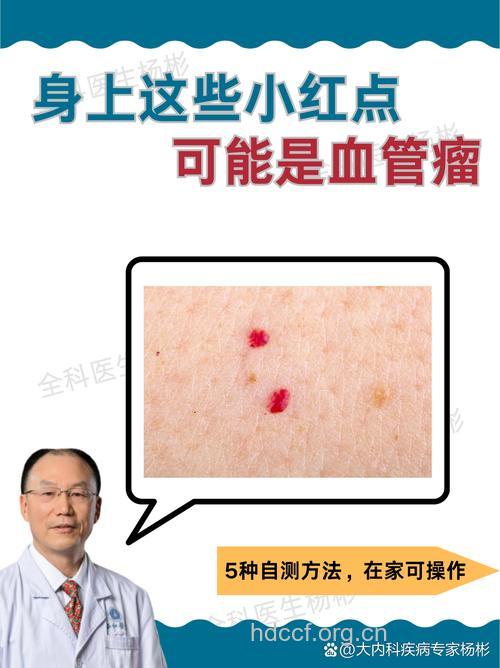 血管瘤初步诊断的方法有哪些