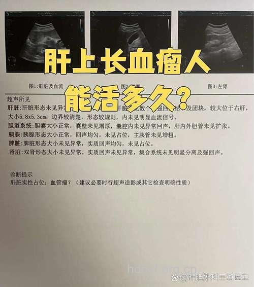 肝血管瘤患者能活多久