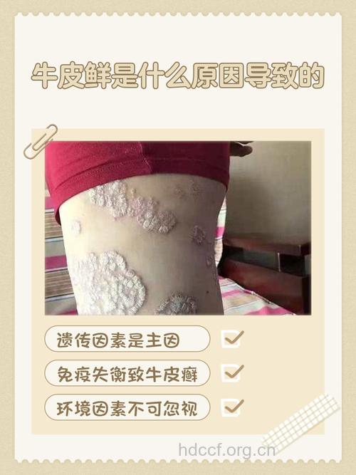 牛皮癣发病的根源在哪儿