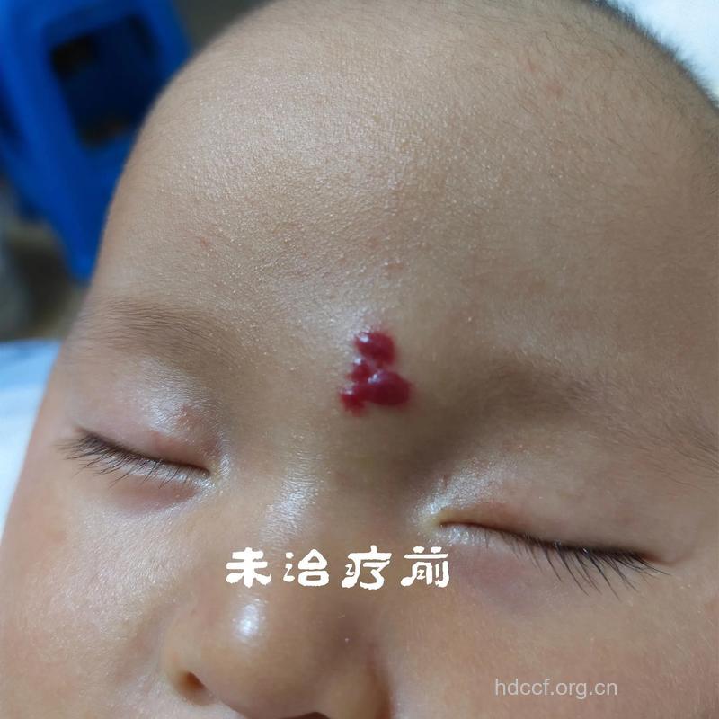 不同类型的皮肤血管瘤如何治疗