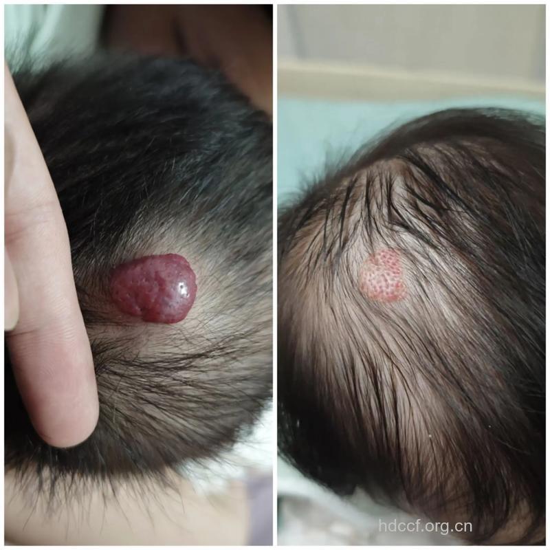 头部血管瘤有什么样的症状