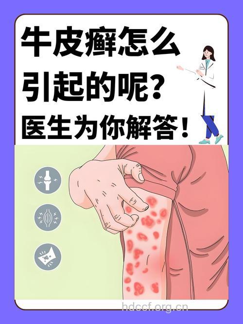 居住地也会影响牛皮癣发病