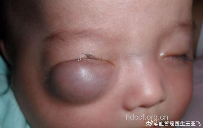 眼眶血管瘤的临床表现