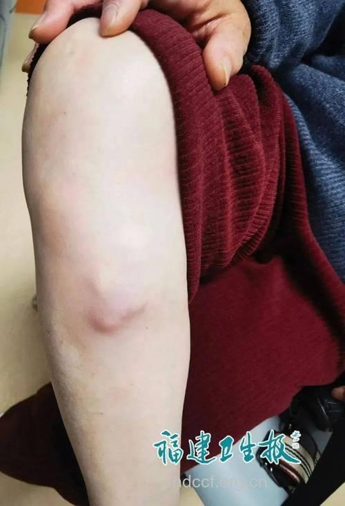 不起眼红色小包竟是恶性肿瘤