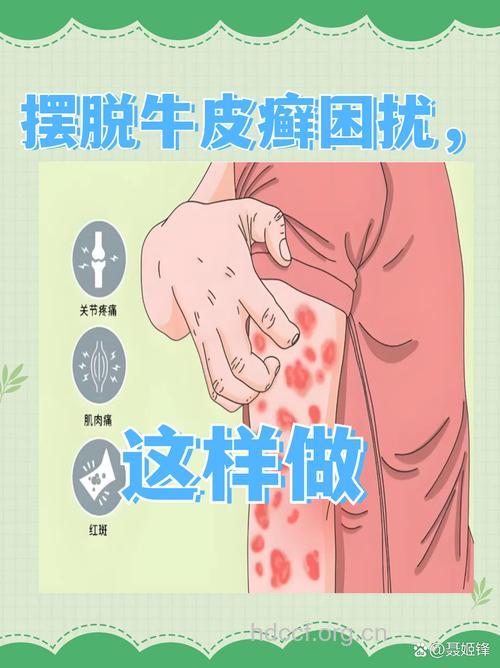 全身牛皮癣辅助治疗的8个方法