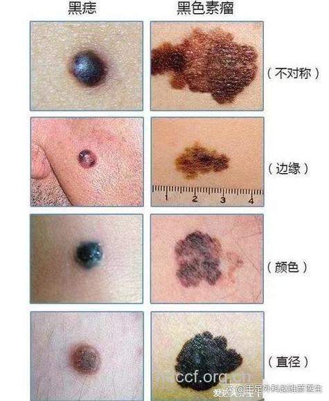 得了黑色素瘤会死吗
