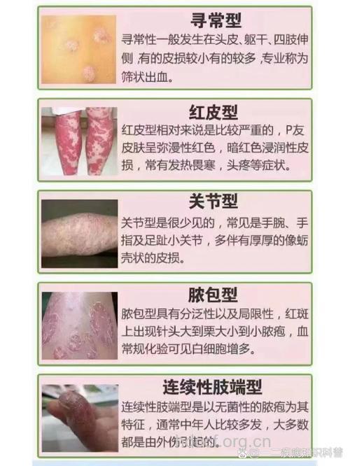 牛皮癣的六种类型介绍