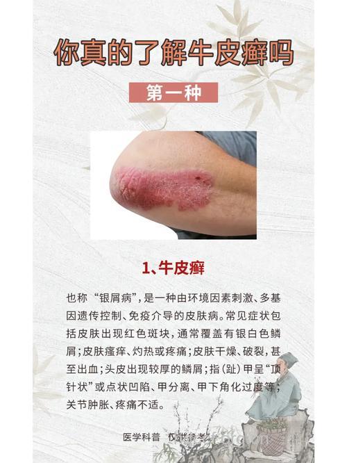 怎样诊断出来是否是银屑病