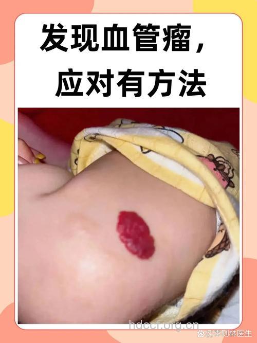 婴儿血管瘤有哪些症状