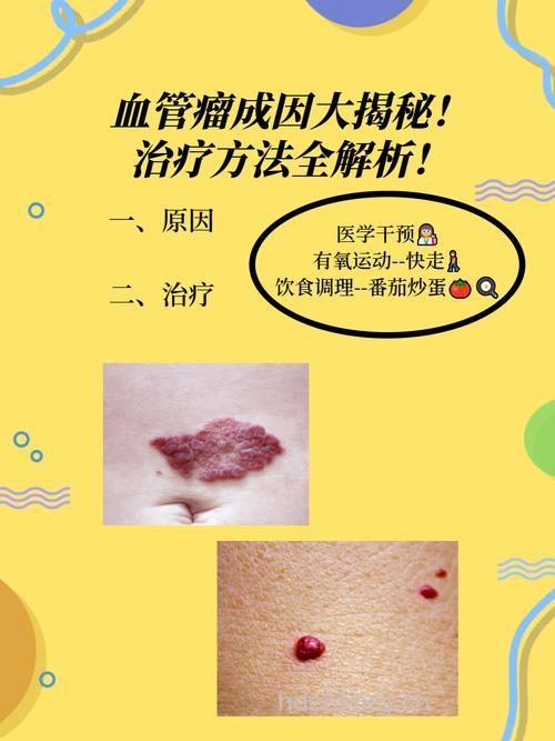 诱发血管瘤的三大原因