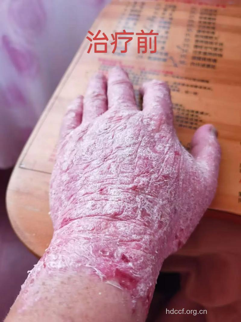 哪个季节治疗牛皮癣的效果最好