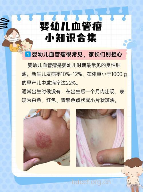 婴儿血管瘤的治疗方法有哪些