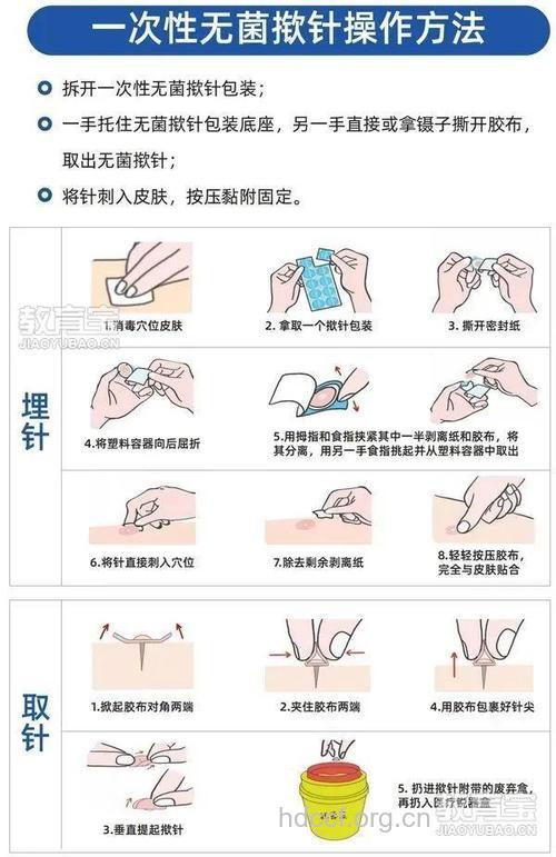 牛皮癣的埋线治疗方法