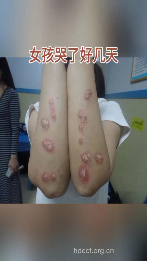 喝酒的女性最易得牛皮癣