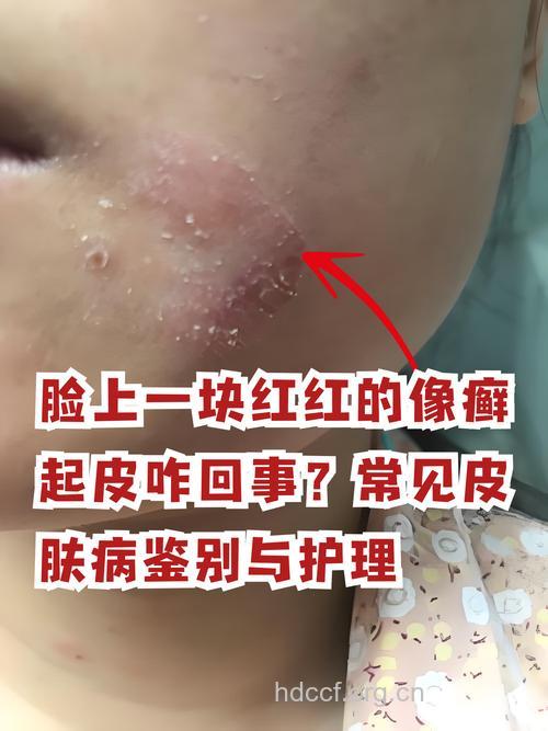 面部疼痛有可能是牛皮癣的征兆