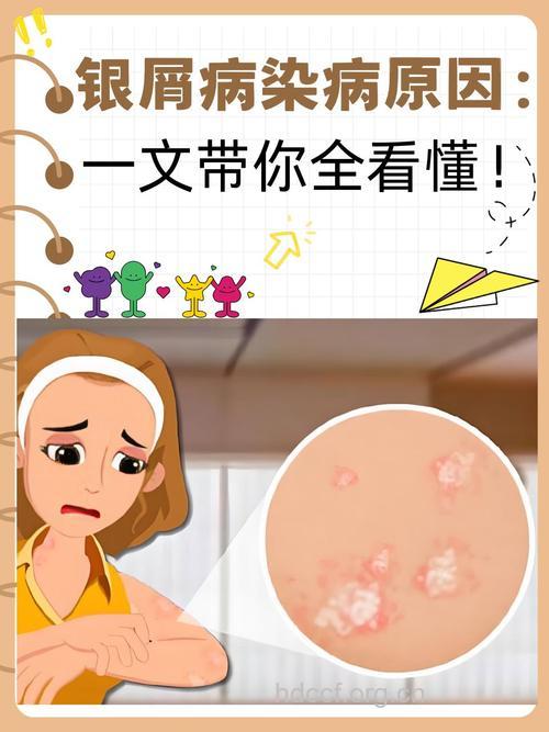 那些你不知道的牛皮癣致病因素