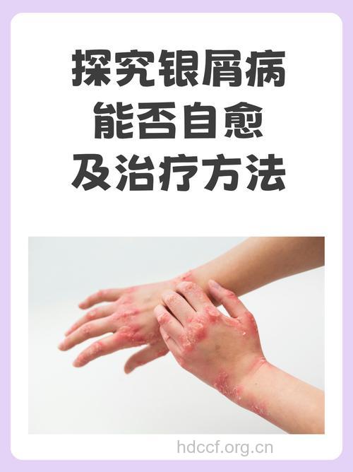 生活太自我，银屑病易找上门