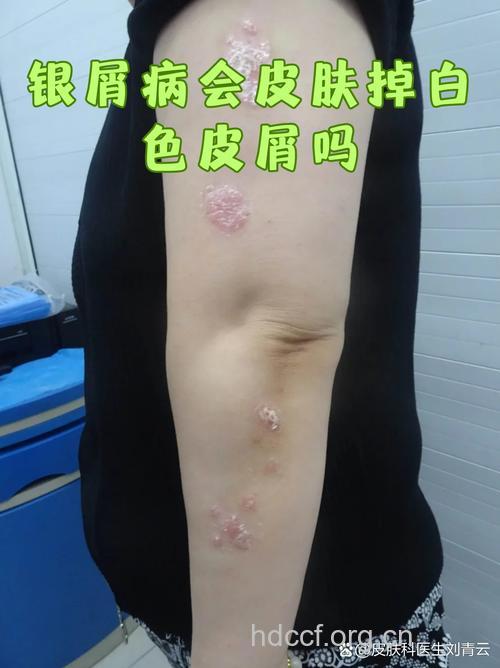 银屑病雪花皮屑的缘故