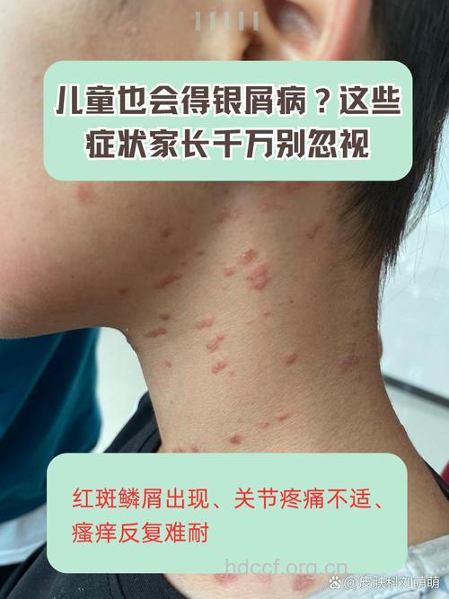 儿童老年人群银屑病发病特点