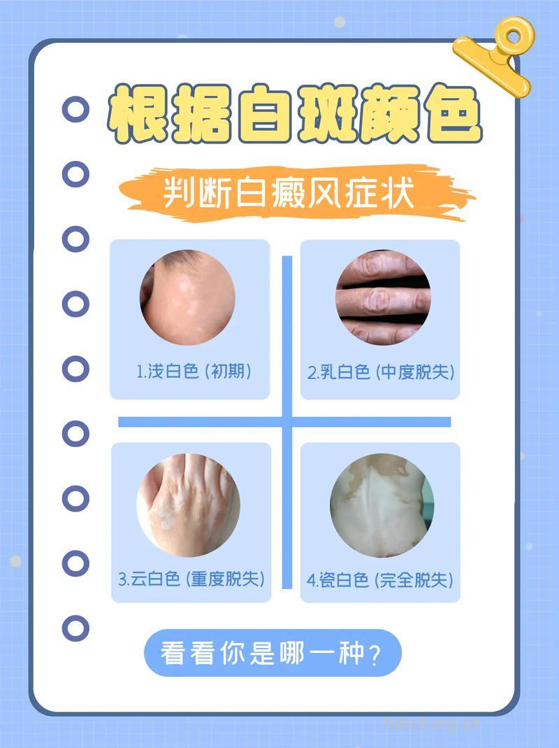 我们应哪些根据症状来诊断白癜风