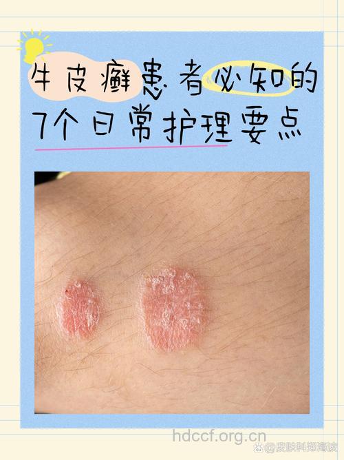 牛皮癣患者身上痒该怎么办