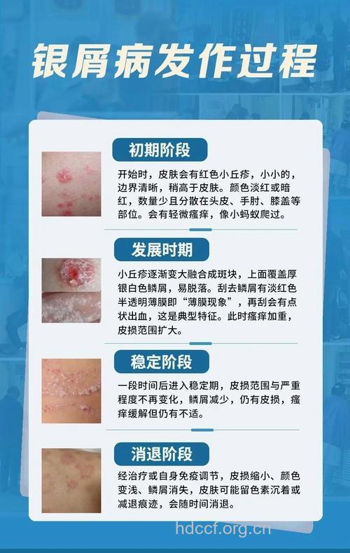 银屑病的发病是什么原因造成的