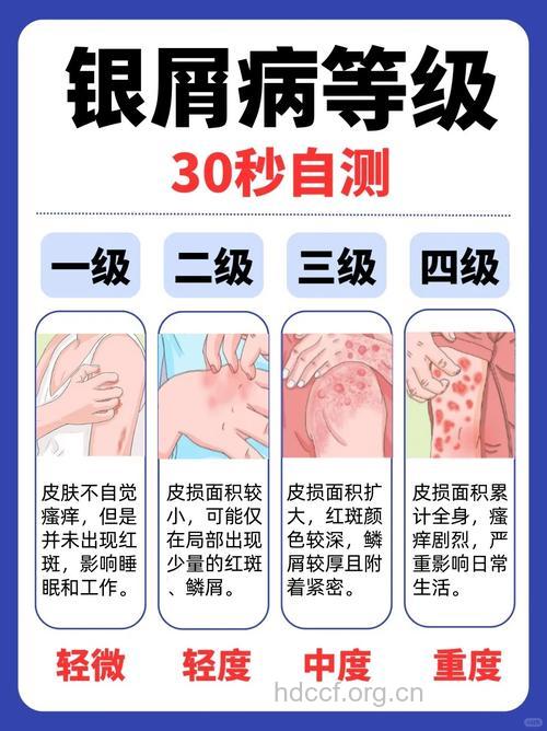 银屑病的病因与什么有关