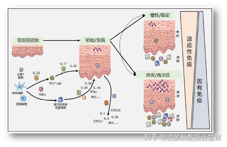 银屑病的发病机理是怎样的