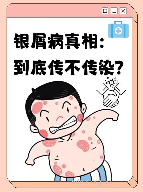 对待感冒一样对待银屑病