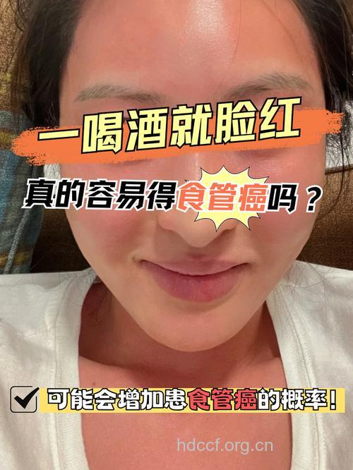 喝酒脸红易患食道癌吗