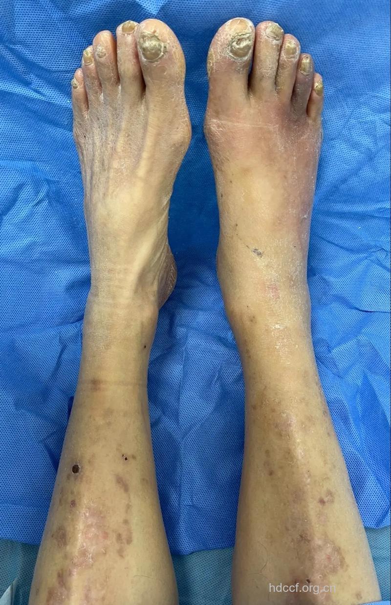 糖尿病的病根在哪里?