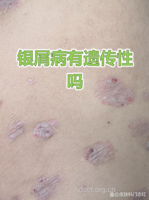 银屑病有遗传性吗