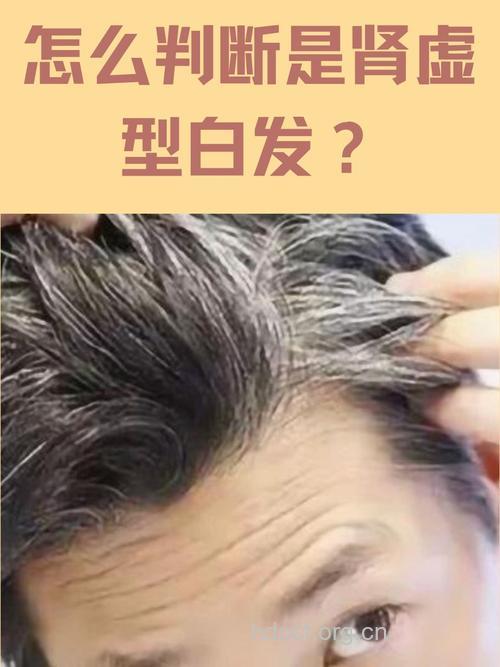 肾虚 让男人早生白发