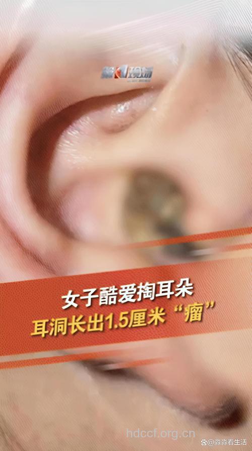 常掏耳朵会长肿瘤吗