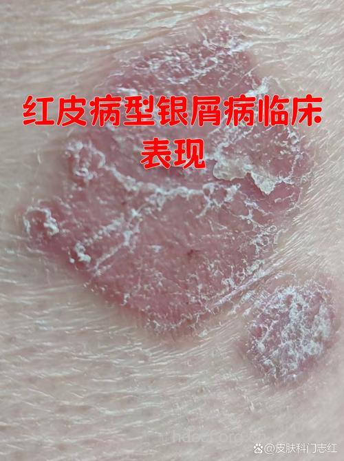 红皮病银屑病临床表现