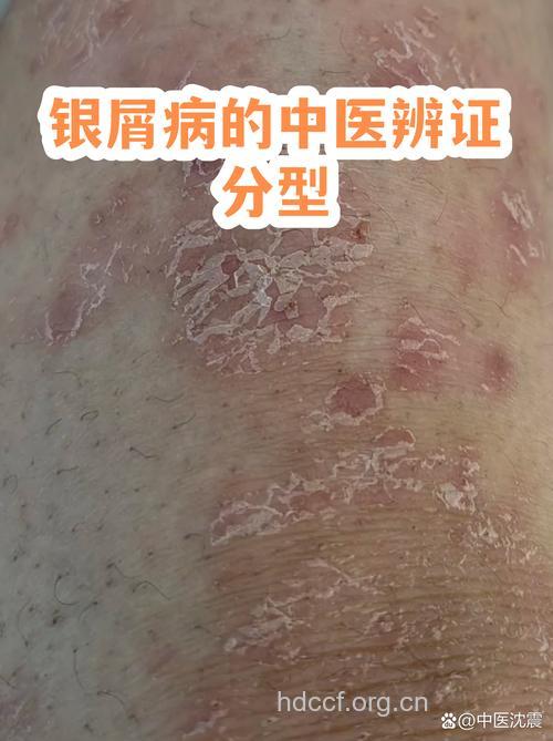 用中医辩证银屑病