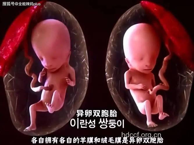 奇:糖尿病竟然也有“双胞胎”!