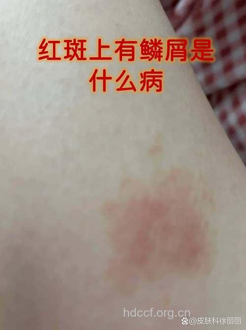 红斑上有鳞屑并非一定是银屑病