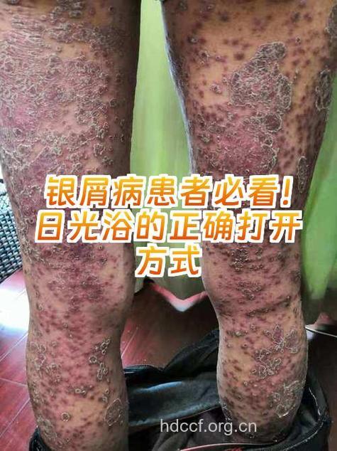 桑那浴对银屑病有疗效吗？