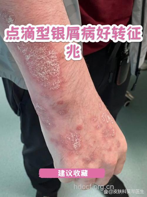 点滴状银屑病有何特点？