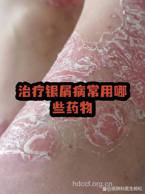 难治银屑病 药粥来缓解
