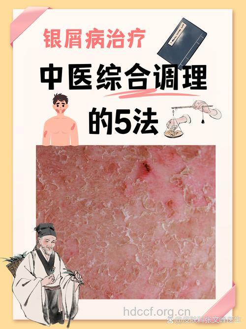 湿热型银屑病中医治疗六法