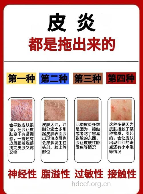 恼人的神经性皮炎，该怎么治