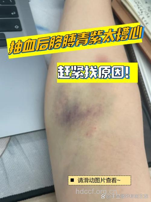 抽血后出现淤青 是身体有问题吗?