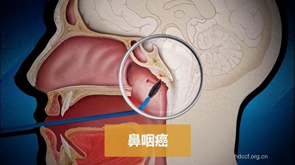 鼻咽癌是什么引起的呢